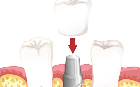Implant crowns
