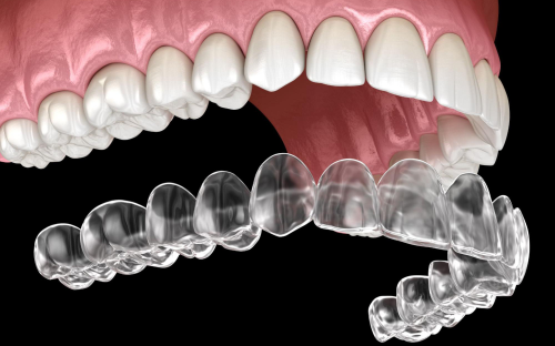Aligner 1